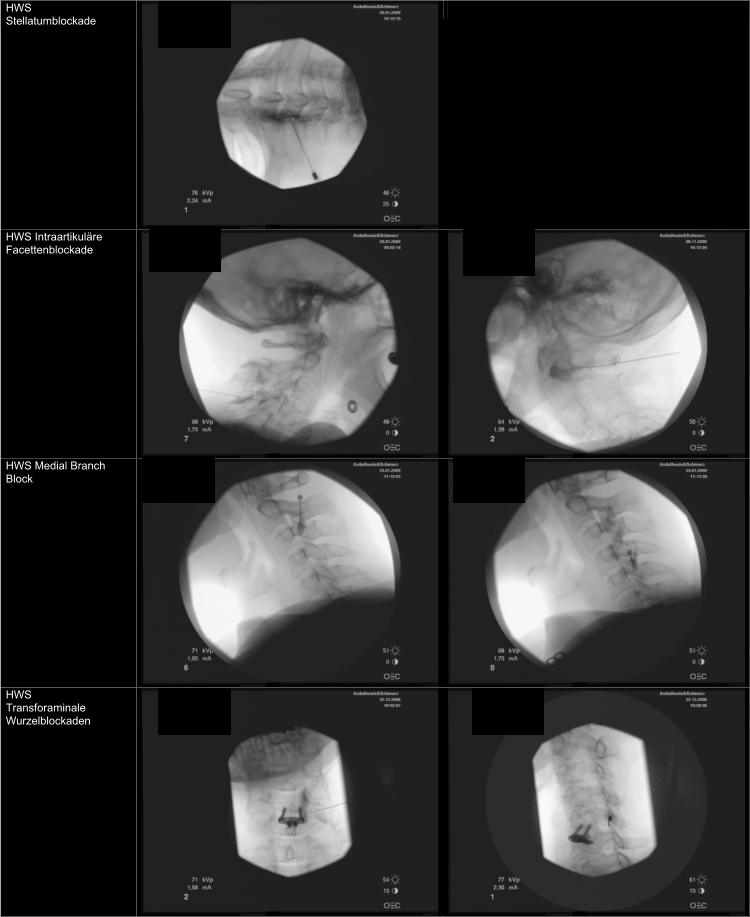 HWS  Stellatumblockade HWS Intraartikuläre Facettenblockade HWS Medial Branch  Block HWS  Transforaminale  Wurzelblockaden